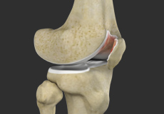 Chondromalacia Patella