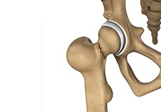 Hip Fracture Surgery