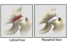 Hip Labral Repair