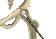 Silent Hip Implant