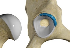 Hip Trauma Reconstruction