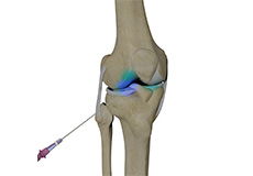 Intraarticluar Knee Injection