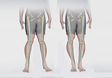 Knee Angular Deformities