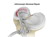 Meniscal Surgery