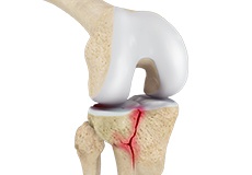 Knee Fracture Surgery