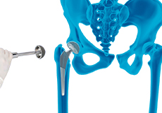 Robotic Assisted Hip Surgery