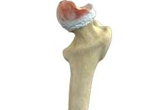 Hip Osteonecrosis