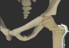 Proximal Femoral Osteotomy