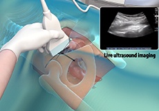 Ultrasound Guided Hip Injections